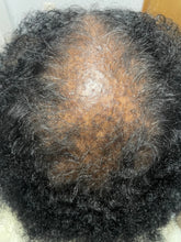 Load image into Gallery viewer, Before using scalp restore oil, client has tight, clogged , inflamed follicles caused by CCCA.