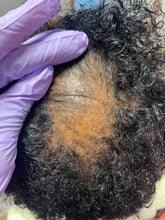 Load image into Gallery viewer, After consistent use of scalp restore oil there has been significant reversal of tight, inflamed, clogged follicles due to CCCA as in the previous photo